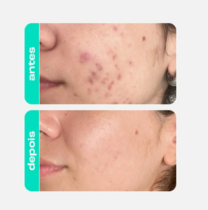 Sérum Antiacne Defense 5D 30mL Creamy